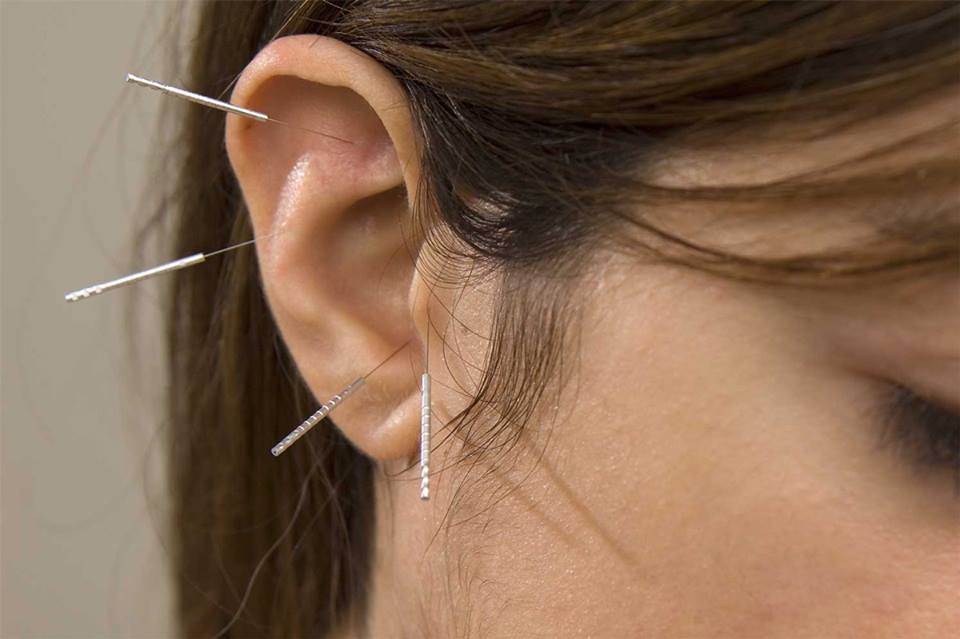 the daith piercing for migraines